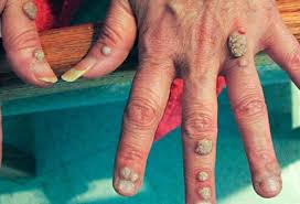 Warts are raised bumps on your skin caused by the human papillomavirus (hpv). Plantar Warts Picture Image On Medicinenet Com