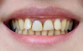 The professionals will be able to safely whiten your teeth with the knowledge of how to whiten sensitive teeth. Orthodontics Complete Smiles