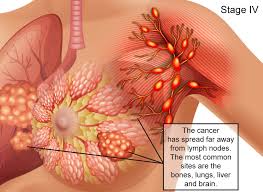 Some common signs of metastatic cancer include: Breast Cancer Signs Symptoms Stages Treatment About Risk Factors Ashray