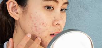Image result for acne face