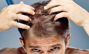 Le manifestazioni dell'alopecia androgenetica risultano diverse nei due sessi. Calvizie Giovanile Sintomi Effetti Cause E Rimedi