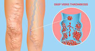 La trombosi arteriosa è solitamente causata da trombo occlusivo che colpisce principalmente le arterie cerebrali e femorali. Trombosi Venosa Profonda Tvp Sintomi Cause E Terapia Ohga