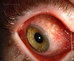 Parinaud Oculoglandular Syndrome
