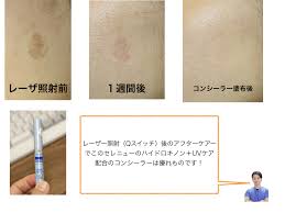 シミ取りレーザー後のケア | 横浜市鶴見の形成・美容外科 エムズクリニック