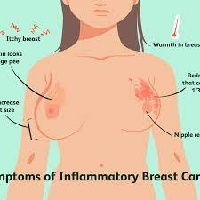 Inflammatory breast cancer (ibc) is rare and is sometimes thought to be some kind of infection. Inflammatory Breast Cancer Overview And More
