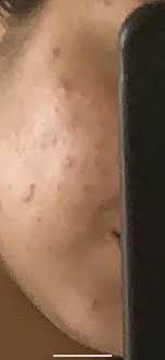 We did not find results for: Unreine Haut Akne Pickelmale Pickel Aknenarben