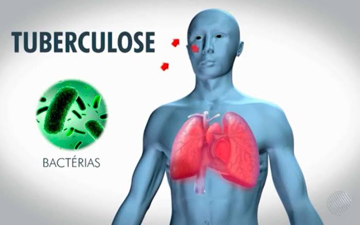 Resultado de imagem para tuberculose"