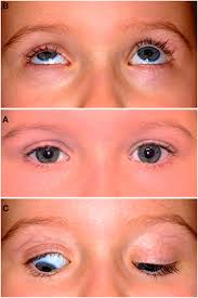 Image result for Eyelid Closure Defect
