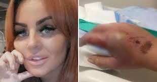 Mum may need skin graft after being burnt by sparklers that caught fire