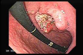 Screening for stomach cancer unfortunately, there's no recommended screening test for spotting early gastric cancer in the general population. Gastric Adenocarcinoma The Gastrointestinal Atlas Gastrointestinalatlas Com