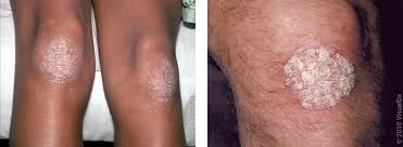 Image result for allergy rash on the legs