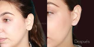 Claudia's case : Before and after Lobuloplasty : FB