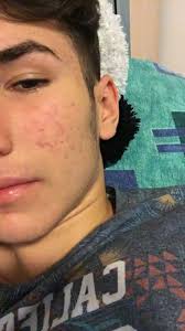 Almost finished roaccutane and got scars*pics*