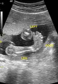 While it can't be treated until the baby is born, knowing what to expect can help the. Talipes Equinovaris Club Foot Ultrasound Sonography Sonography Student Sonography