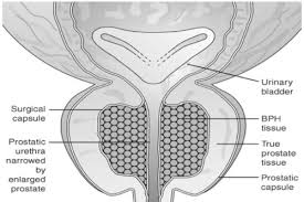 Most men with early prostate cancer don't have any signs or symptoms. Gu 2 Prostate Scrotum Testes Flashcards Quizlet