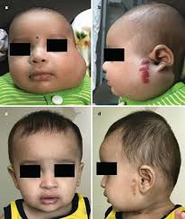 Endovascular Management of Vascular Malformations