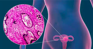 Aumenta el número de casos de mujeres jóvenes con cáncer cervicouterino