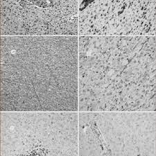 La esclerosis múltiple es una enfermedad crónica, con una clínica muy variable que evoluciona de manera diferente en cada caso. Pdf Revision Aspectos Patofisiologicos De La Esclerosis Multiple