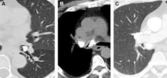 Image result for Broncholithiasis