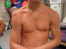 Sports injuries, especially in contact sports 2. Shoulder Dislocation Core Em
