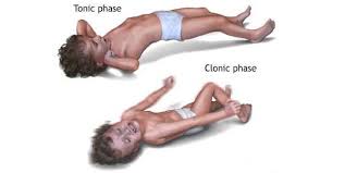 convulsions