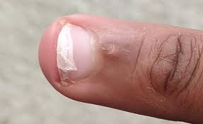How Do I Fix A Nail With The Top Layer Peeling Off I Was Trying To Open A Box And The Top Layer Of My Middle Finger Got Pulled Off When I