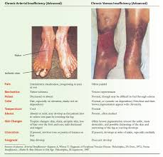 Image Result For Arterial Vs Venous Insufficiency Lpn