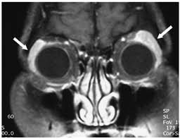 Image result for Dacryoadenitis