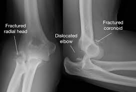 Image result for Radial Head Dislocation