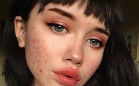 Ampuh menghilangkan jerawat, begini cara tepat mengaplikasikan tea tree oil menurut dermatolog. 5 Perawatan Rumahan Untuk Menghilangkan Blackhead Okezone Lifestyle
