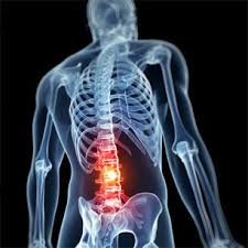 Car accident back pain compensation. Compensation For Spinal Cord Injuries Following An Accident Mahaney Pappas Llp