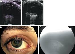Retinal detachment surgery involves reattaching the retina to the back of the eye and sealing any breaks or holes in the retina. Analysis Of Lesions Before And After Surgery A B Echography Before Download Scientific Diagram
