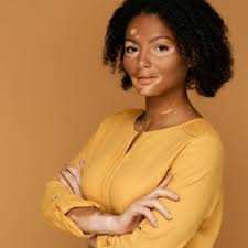 Image result for Vitiligo