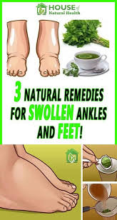 3 Natural Remedies For Swollen Ankles And Feet Foot Remedies Migraines Remedies Water Retention Remedies