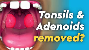 Tonsillectomy Children S Hospital Colorado