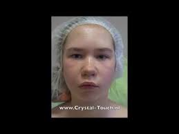Congenital Facial Paralysis. Nadja (14) after 2 Crystal Touch treatments.  Moscow.