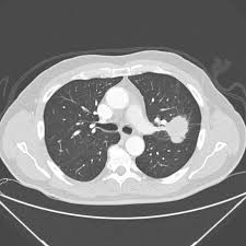 It is imperative that you see your physician if you are experiencing persistent signs and symptoms of lung cancer, have worked with asbestos, or were a smoker. Lung Cancer Staging Iaslc 8th Edition Radiology Reference Article Radiopaedia Org