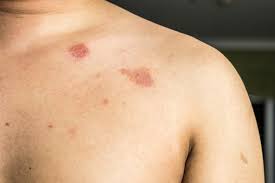 Kulat tumbuh dengan baik dalam panas. 8 Cara Berkesan Menghilangkan Kurap Di Kulit Badan Productnation