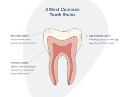 Our teeth whitening pen gel is vegan, gluten free, and sugar free. Stained Teeth 101 How To Prevent And Clean Stains From Wine Coffee And More