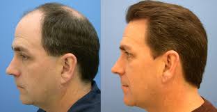 90 Discount Consultation Hair Transplant Dr Rana Aesthetic Health Center Riffa Bahrain