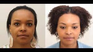 In eyebrow transplantation, the hairs above the ears or from the back of the head are transplanted to the brow. Fue Hair Transplant Black Women African 1382 Grafts Full Shaven Hair Transplant Hair Loss Remedies Fue Hair Transplant