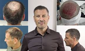 We would like to show you a description here but the site won't allow us. Former Premier League Ref Mark Clattenburg Gets Transplant Surgery Daily Mail Online