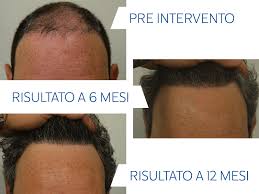 L'età degli uomini interessati a questo tipo d'intervento oscilla tra i 20 e i 60. Alopecia Sottoporsi Ad Un Trapianto Capelli Istituto Helvetico Sanders