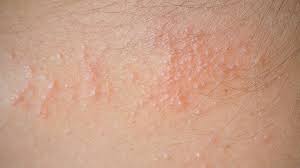 The best manner to treat contact dermatitis is avoidance. Causes Of Summertime Rashes Everyday Health