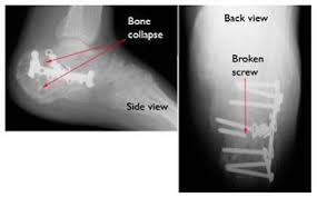 Image result for Calcaneus Compression Fracture