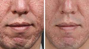 Do you have acne scars, stretch marks, fine lines or wrinkles, uneven skin tone or texture, or large your licensed medical aesthetician will use the micropen or collagen pin in a precise and controlled manner to treat the affected areas on your skin, and may follow up with a topical skin care solution. Microneedling For Acne Scars Effectiveness Side Effects And Costs