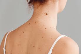 Rodinki Na Tele Kak Opredelit Opasnye I Mozhno Li Udalyat Zdorove Rbk Stil