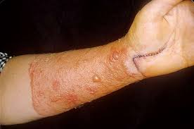 как избавиться от экземы на руках в домашних условиях Https Xn 80aadc3bb0afph1dp3h Xn P1ai Allergiya Mazi I Kremy Ot Dermatita Na Kozhe U Vzroslyh Html