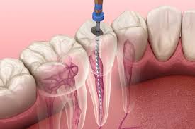 Das absterben des inneren des zahns, der pulpa vor einigen jahren wurden in solchen fällen die zähne gezogen. Endodontie Zahnheilkunde Kirchberg