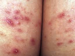 It is an infection on the skin that starts as a reddened. Folliculitis Dermnet Nz